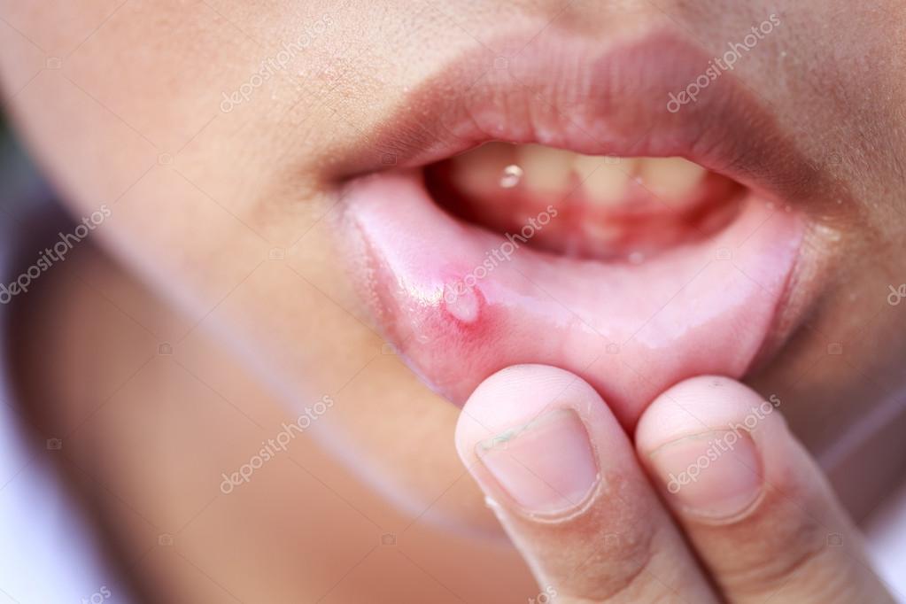 口内炎へのレーザー照射のイメージ